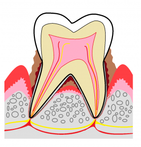 臼歯部　歯周病　重度　その１